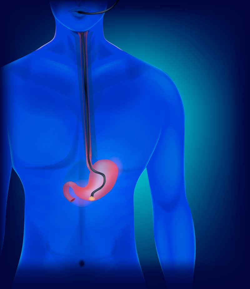 endoscopia_digestiva_alta Endoscopia Digestiva Alta