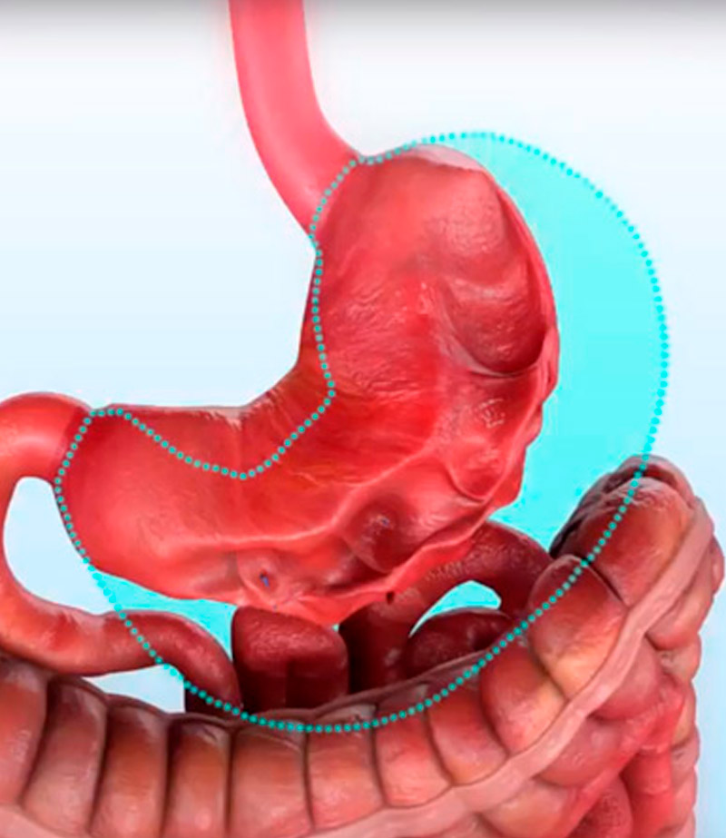 gastroplastia endoscopica